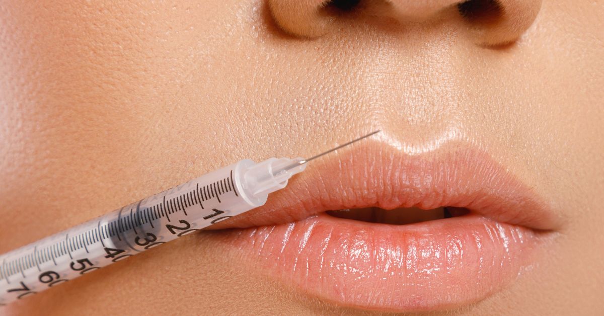 Image of an injection by the lips for collagen fillers which are made of purified proteins